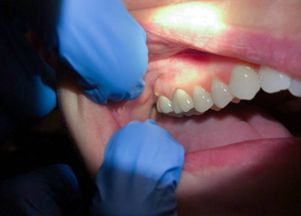 Best Dentist for Tooth Abscess  in Vinco, PA